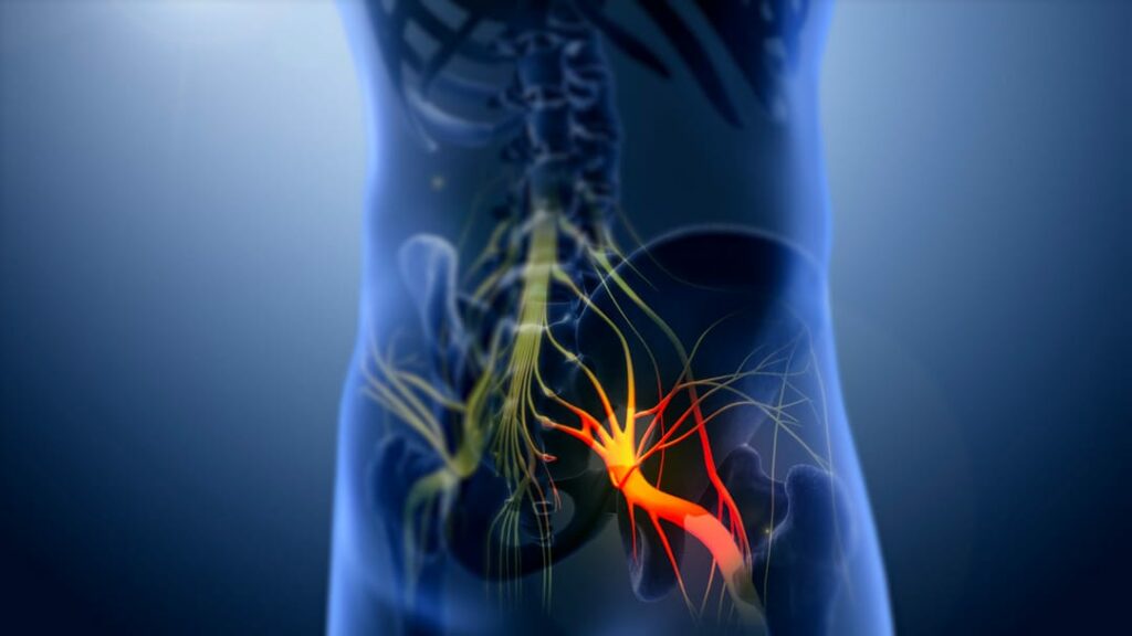 4) SINDROME DEL PIRIFORME O DEEP GLUTEAL PAIN SYNDROME?